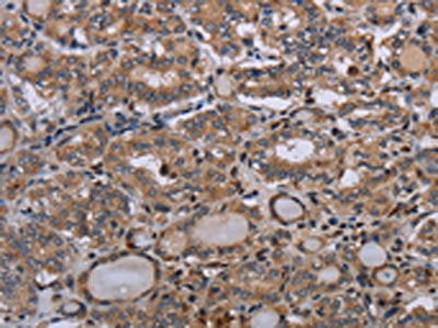 The image on the left is immunohistochemistry of paraffin-embedded Human thyroid cancer tissue using the antibody Antibody) at dilution 1/50, on the right is treated with synthetic peptide. (Original magnification: ×200)Rabbit anti-Human P2RX2 Polyclonal Antibody