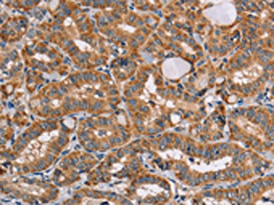 The image on the left is immunohistochemistry of paraffin-embedded Human thyroid cancer tissue using the antibody Antibody) at dilution 1/20, on the right is treated with fusion protein. (Original magnification: ×200)
