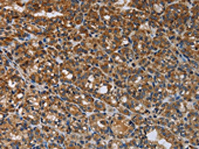 The image on the left is immunohistochemistry of paraffin-embedded Human thyroid cancer tissue using LGALS2 Antibody(LGALS2 Antibody) at dilution 1/30, on the right is treated with fusion protein. (Original magnification: ×200)