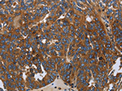 The image on the left is immunohistochemistry of paraffin-embedded Human ovarian cancer tissue using the antibody Antibody) at dilution 1/30, on the right is treated with fusion protein. (Original magnification: ×200)