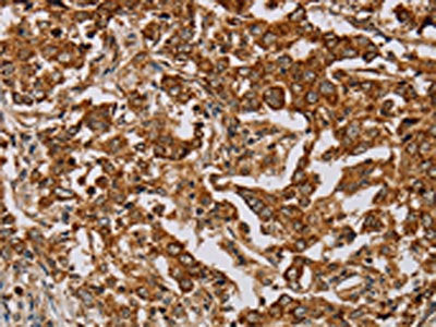 The image on the left is immunohistochemistry of paraffin-embedded Human liver cancer tissue using MB Antibody(MB Antibody) at dilution 1/25, on the right is treated with fusion protein. (Original magnification: ×200)