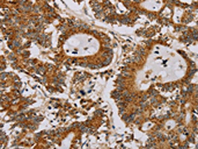 The image on the left is immunohistochemistry of paraffin-embedded Human colon cancer tissue using the antibody Antibody) at dilution 1/25, on the right is treated with fusion protein. (Original magnification: ×200)