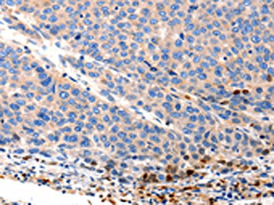 The image on the left is immunohistochemistry of paraffin-embedded Human liver cancer tissue using OLR1 Antibody(OLR1 Antibody) at dilution 1/12, on the right is treated with synthetic peptide. (Original magnification: ×200)Rabbit anti-Human OLR1 Polyclonal Antibody
