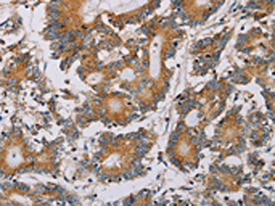 The image on the left is immunohistochemistry of paraffin-embedded Human colon cancer tissue using PLEKHG6 Antibody(PLEKHG6 Antibody) at dilution 1/20, on the right is treated with fusion protein. (Original magnification: ×200)Rabbit anti-Human PLEKHG6 Polyclonal Antibody