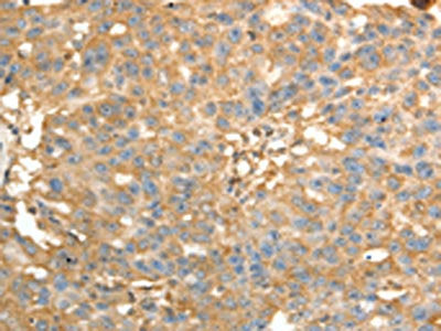 The image on the left is immunohistochemistry of paraffin-embedded Human ovarian cancer tissue using PSMD9 Antibody(PSMD9 Antibody) at dilution 1/40, on the right is treated with fusion protein. (Original magnification: ×200)Rabbit anti-Human PSMD9 Polyclonal Antibody