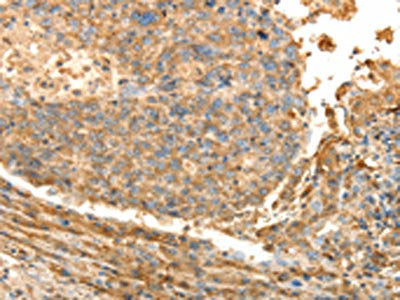 The image on the left is immunohistochemistry of paraffin-embedded Human liver cancer tissue using the antibody Antibody) at dilution 1/40, on the right is treated with fusion protein. (Original magnification: ×200)Rabbit anti-Human PSMD9 Polyclonal Antibody
