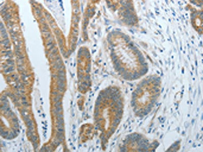 The image on the left is immunohistochemistry of paraffin-embedded Human colon cancer tissue using CXCR3 Antibody(CXCR3 Antibody) at dilution 1/15, on the right is treated with fusion protein. (Original magnification: ×200)Rabbit anti-Human CXCR3 Polyclonal Antibody