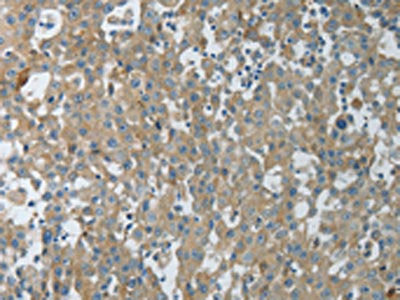 The image on the left is immunohistochemistry of paraffin-embedded Human breast cancer tissue using the antibody Antibody) at dilution 1/15, on the right is treated with fusion protein. (Original magnification: ×200)Rabbit anti-Human CXCR3 Polyclonal Antibody