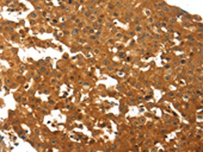The image on the left is immunohistochemistry of paraffin-embedded Human breast cancer tissue using TNFRSF11B Antibody(TNFRSF11B Antibody) at dilution 1/30, on the right is treated with fusion protein. (Original magnification: ×200)Rabbit anti-Human TNFRSF11B Polyclonal Antibody
