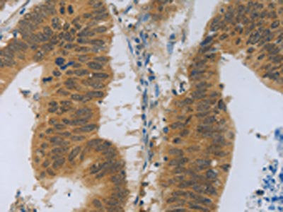 The image on the left is immunohistochemistry of paraffin-embedded Human colon cancer tissue using the antibody Antibody) at dilution 1/30, on the right is treated with fusion protein. (Original magnification: ×200)Rabbit anti-Human TNFRSF11B Polyclonal Antibody