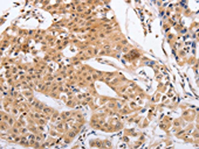 The image on the left is immunohistochemistry of paraffin-embedded Human lung cancer tissue using RCHY1 Antibody(RCHY1 Antibody) at dilution 1/30, on the right is treated with fusion protein. (Original magnification: ×200)Rabbit anti-Human RCHY1 Polyclonal Antibody