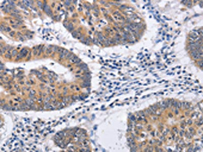 The image on the left is immunohistochemistry of paraffin-embedded Human colon cancer tissue using the antibody Antibody) at dilution 1/30, on the right is treated with fusion protein. (Original magnification: ×200)Rabbit anti-Human RCHY1 Polyclonal Antibody