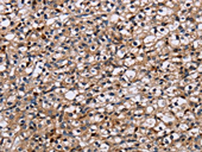 The image on the left is immunohistochemistry of paraffin-embedded Human prostate cancer tissue using NCSTN Antibody(NCSTN Antibody) at dilution 1/50, on the right is treated with fusion protein. (Original magnification: ×200)Rabbit anti-Human NCSTN Polyclonal Antibody