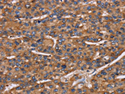 The image on the left is immunohistochemistry of paraffin-embedded Human liver cancer tissue using the antibody Antibody) at dilution 1/50, on the right is treated with fusion protein. (Original magnification: ×200)Rabbit anti-Human NCSTN Polyclonal Antibody