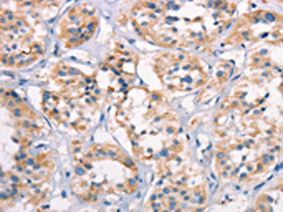 The image on the left is immunohistochemistry of paraffin-embedded Human thyroid cancer tissue using SPR Antibody(SPR Antibody) at dilution 1/20, on the right is treated with synthetic peptide. (Original magnification: ×200)Rabbit anti-Human SPR Polyclonal Antibody