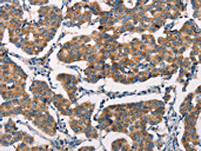 The image on the left is immunohistochemistry of paraffin-embedded Human breast cancer tissue using the antibody Antibody) at dilution 1/20, on the right is treated with synthetic peptide. (Original magnification: ×200)Rabbit anti-Human SPR Polyclonal Antibody