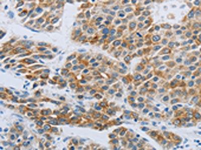 The image on the left is immunohistochemistry of paraffin-embedded Human liver cancer tissue using P2RY4 Antibody(P2RY4 Antibody) at dilution 1/30, on the right is treated with synthetic peptide. (Original magnification: ×200)Rabbit anti-Human P2RY4 Polyclonal Antibody