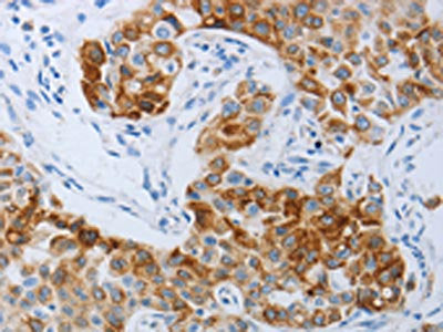 The image on the left is immunohistochemistry of paraffin-embedded Human lung cancer tissue using the antibody Antibody) at dilution 1/30, on the right is treated with synthetic peptide. (Original magnification: ×200)Rabbit anti-Human P2RY4 Polyclonal Antibody