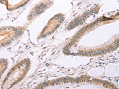 The image on the left is immunohistochemistry of paraffin-embedded Human colon cancer tissue using ADAM11 Antibody(ADAM11 Antibody) at dilution 1/25, on the right is treated with synthetic peptide. (Original magnification: ×200)Rabbit anti-Human ADAM11 Polyclonal Antibody