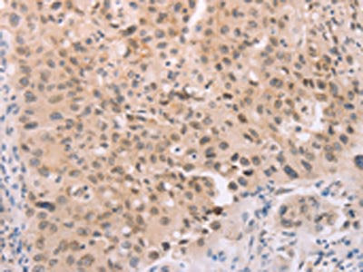 The image on the left is immunohistochemistry of paraffin-embedded Human lung cancer tissue using the antibody Antibody) at dilution 1/25, on the right is treated with synthetic peptide. (Original magnification: ×200)