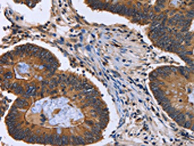 The image is immunohistochemistry of paraffin-embedded Human colon cancer tissue using the antibody Antibody) at dilution 1/40. (Original magnification: ×200)Rabbit anti-Human FRK Polyclonal Antibody