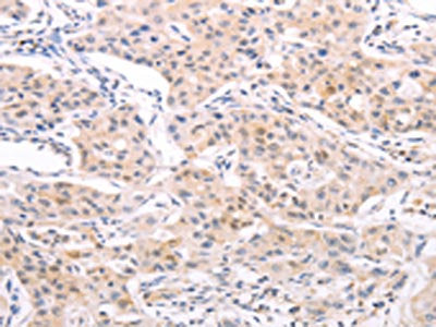 The image on the left is immunohistochemistry of paraffin-embedded Human lung cancer tissue using NAMPT Antibody(NAMPT Antibody) at dilution 1/15, on the right is treated with fusion protein. (Original magnification: ×200)Rabbit anti-Human NAMPT Polyclonal Antibody