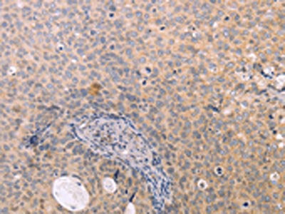 The image on the left is immunohistochemistry of paraffin-embedded Human cervical cancer tissue using the antibody Antibody) at dilution 1/15, on the right is treated with fusion protein. (Original magnification: ×200)Rabbit anti-Human NAMPT Polyclonal Antibody
