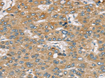The image on the left is immunohistochemistry of paraffin-embedded Human liver cancer tissue using SENP1 Antibody(SENP1 Antibody) at dilution 1/35, on the right is treated with synthetic peptide. (Original magnification: ×200)Rabbit anti-Human SENP1 Polyclonal Antibody