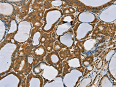 The image on the left is immunohistochemistry of paraffin-embedded Human thyroid cancer tissue using the antibody Antibody) at dilution 1/35, on the right is treated with synthetic peptide. (Original magnification: ×200)Rabbit anti-Human SENP1 Polyclonal Antibody