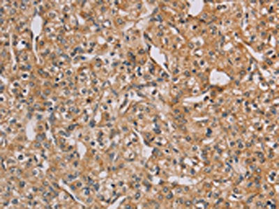 The image on the left is immunohistochemistry of paraffin-embedded Human prostate cancer tissue using the antibody Antibody) at dilution 1/20, on the right is treated with fusion protein. (Original magnification: ×200)Rabbit anti-Human CHRNA4 Polyclonal Antibody