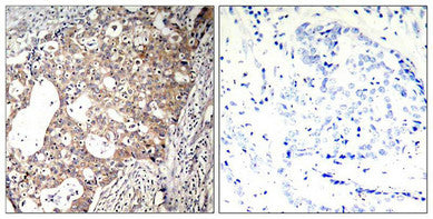 Immunohistochemical analysis of paraffin-embedded human breast carcinoma tissue using Shc1(Phospho-Tyr427) Antibody(left) or the same antibody preincubated with blocking peptide(right).Rabbit anti-Human SHC1 Polyclonal Antibody