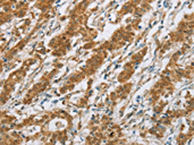 The image on the left is immunohistochemistry of paraffin-embedded Human gastric cancer tissue using CYP2E1 Antibody(CYP2E1 Antibody) at dilution 1/30, on the right is treated with fusion protein. (Original magnification: ×200)Rabbit anti-Human CYP2E1 Polyclonal Antibody