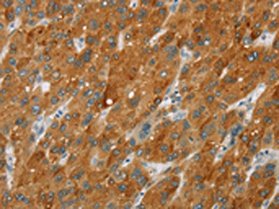 The image on the left is immunohistochemistry of paraffin-embedded Human liver cancer tissue using the antibody Antibody) at dilution 1/30, on the right is treated with fusion protein. (Original magnification: ×200)Rabbit anti-Human CYP2E1 Polyclonal Antibody