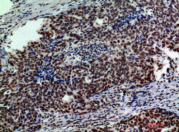 Immunohistochemical analysis of paraffin-embedded human-breast-cancer, antibody was diluted at 1:200Rabbit anti-Human GLB1 Polyclonal Antibody