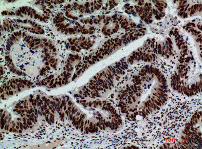 Immunohistochemical analysis of paraffin-embedded human-colont-cancer, antibody was diluted at 1:200Rabbit anti-Human GLB1 Polyclonal Antibody
