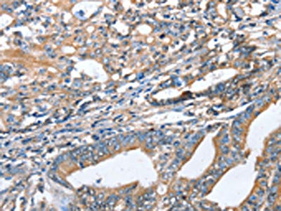 The image on the left is immunohistochemistry of paraffin-embedded Human gastric cancer tissue using AKR1D1 Antibody(AKR1D1 Antibody) at dilution 1/35, on the right is treated with fusion protein. (Original magnification: ×200)Rabbit anti-Human AKR1D1 Polyclonal Antibody