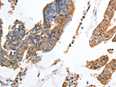 The image on the left is immunohistochemistry of paraffin-embedded Human colon cancer tissue using the antibody Antibody) at dilution 1/35, on the right is treated with fusion protein. (Original magnification: ×200)Rabbit anti-Human AKR1D1 Polyclonal Antibody