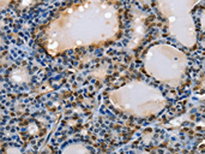 The image on the left is immunohistochemistry of paraffin-embedded Human thyroid cancer tissue using NFKBID Antibody(NFKBID Antibody) at dilution 1/40, on the right is treated with fusion protein. (Original magnification: ×200)Rabbit anti-Human NFKBID Polyclonal Antibody