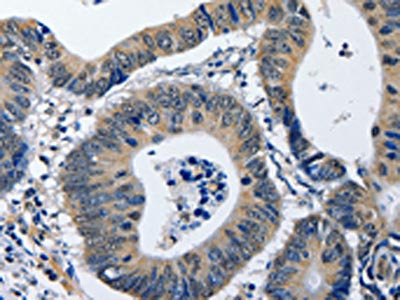 The image on the left is immunohistochemistry of paraffin-embedded Human colon cancer tissue using the antibody Antibody) at dilution 1/40, on the right is treated with fusion protein. (Original magnification: ×200)Rabbit anti-Human NFKBID Polyclonal Antibody
