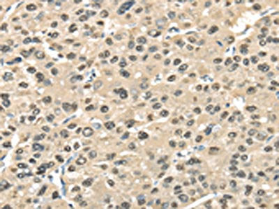The image on the left is immunohistochemistry of paraffin-embedded Human liver cancer tissue using TALDO1 Antibody(TALDO1 Antibody) at dilution 1/30, on the right is treated with fusion protein. (Original magnification: ×200)Rabbit anti-Human TALDO1 Polyclonal Antibody