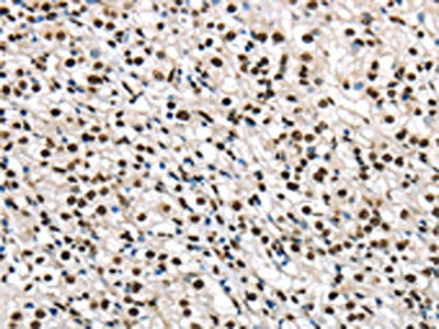 The image on the left is immunohistochemistry of paraffin-embedded Human prostate cancer tissue using the antibody Antibody) at dilution 1/30, on the right is treated with fusion protein. (Original magnification: ×200)Rabbit anti-Human TALDO1 Polyclonal Antibody