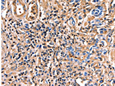 The image on the left is immunohistochemistry of paraffin-embedded Human gastric cancer tissue using ANXA6 Antibody(ANXA6 Antibody) at dilution 1/17, on the right is treated with fusion protein. (Original magnification: ×200)Rabbit anti-Human ANXA6 Polyclonal Antibody