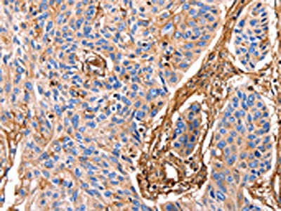 The image on the left is immunohistochemistry of paraffin-embedded Human esophagus cancer tissue using the antibody Antibody) at dilution 1/17, on the right is treated with fusion protein. (Original magnification: ×200)Rabbit anti-Human ANXA6 Polyclonal Antibody
