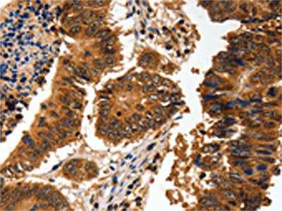 The image on the left is immunohistochemistry of paraffin-embedded Human colon cancer tissue using the antibody Antibody) at dilution 1/60, on the right is treated with fusion protein. (Original magnification: ×200)