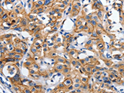 The image on the left is immunohistochemistry of paraffin-embedded Human lung cancer tissue using CDH1 Antibody(CDH1 Antibody) at dilution 1/100, on the right is treated with synthetic peptide. (Original magnification: X200)Rabbit anti-Human CDH1 Polyclonal Antibody