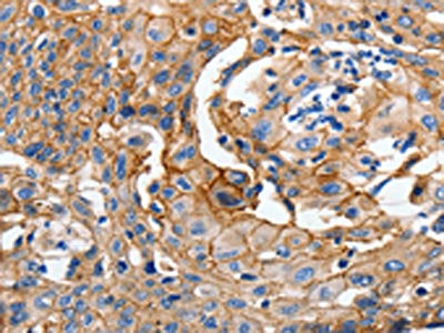 The image on the left is immunohistochemistry of paraffin-embedded Human cervical cancer tissue using the antibody Antibody) at dilution 1/100, on the right is treated with synthetic peptide. (Original magnification: X200)Rabbit anti-Human CDH1 Polyclonal Antibody
