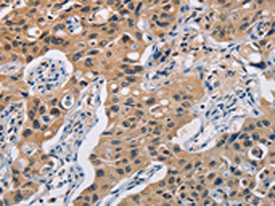 The image on the left is immunohistochemistry of paraffin-embedded Human lung cancer tissue using TLR3 Antibody(TLR3 Antibody) at dilution 1/50, on the right is treated with fusion protein. (Original magnification: ×200)Rabbit anti-Human TLR3 Polyclonal Antibody