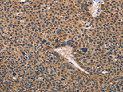 The image on the left is immunohistochemistry of paraffin-embedded Human liver cancer tissue using the antibody Antibody) at dilution 1/50, on the right is treated with fusion protein. (Original magnification: ×200)Rabbit anti-Human TLR3 Polyclonal Antibody
