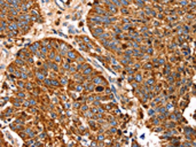 The image on the left is immunohistochemistry of paraffin-embedded Human lung cancer tissue using SLC27A5 Antibody(SLC27A5 Antibody) at dilution 1/20, on the right is treated with synthetic peptide. (Original magnification: ×200)Rabbit anti-Human SLC27A5 Polyclonal Antibody