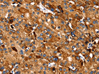 The image on the left is immunohistochemistry of paraffin-embedded Human liver cancer tissue using the antibody Antibody) at dilution 1/20, on the right is treated with synthetic peptide. (Original magnification: ×200)Rabbit anti-Human SLC27A5 Polyclonal Antibody